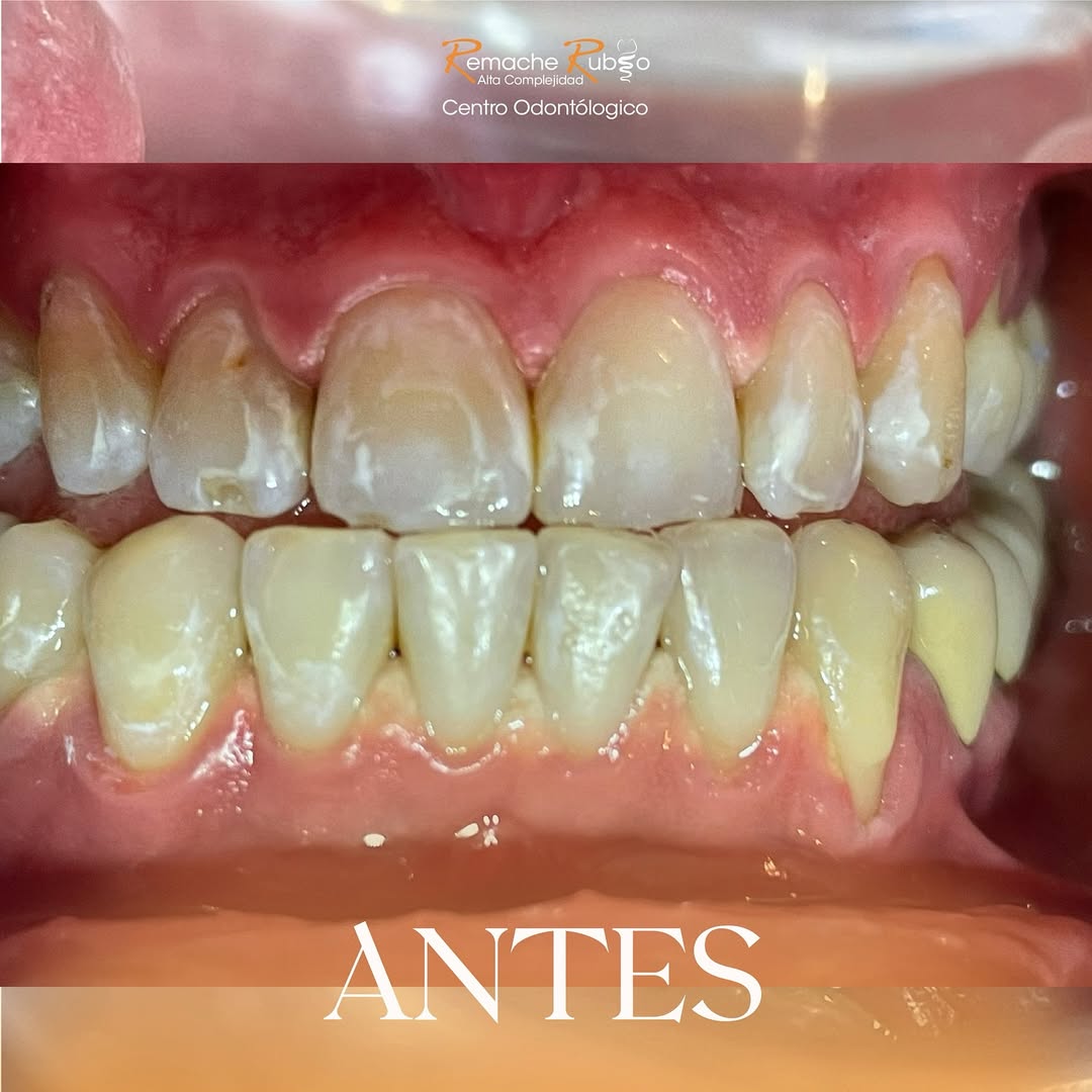 Antes: dientes desgastados antes de las carillas — caso real