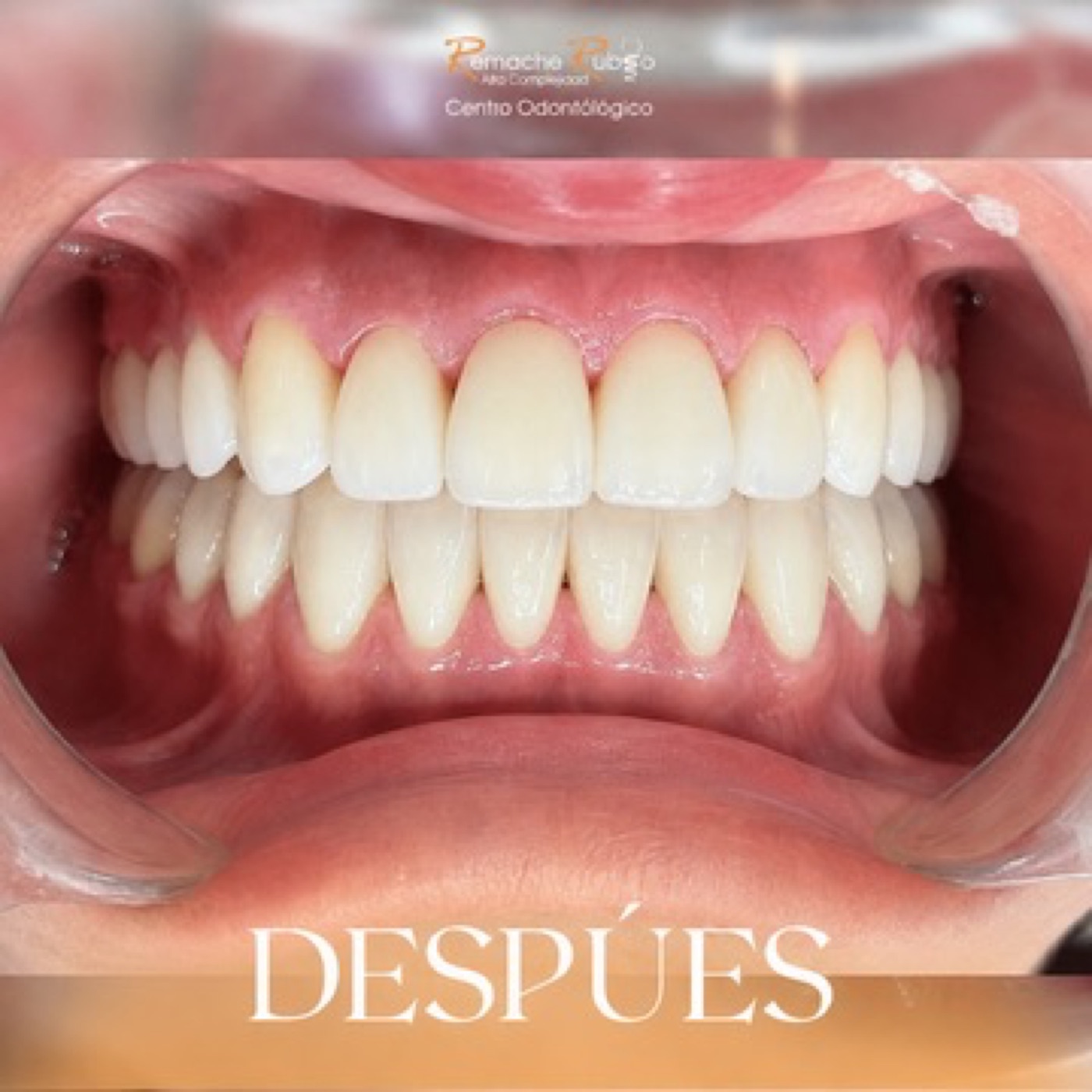 Resultado: sonrisa luminosa y natural con carillas