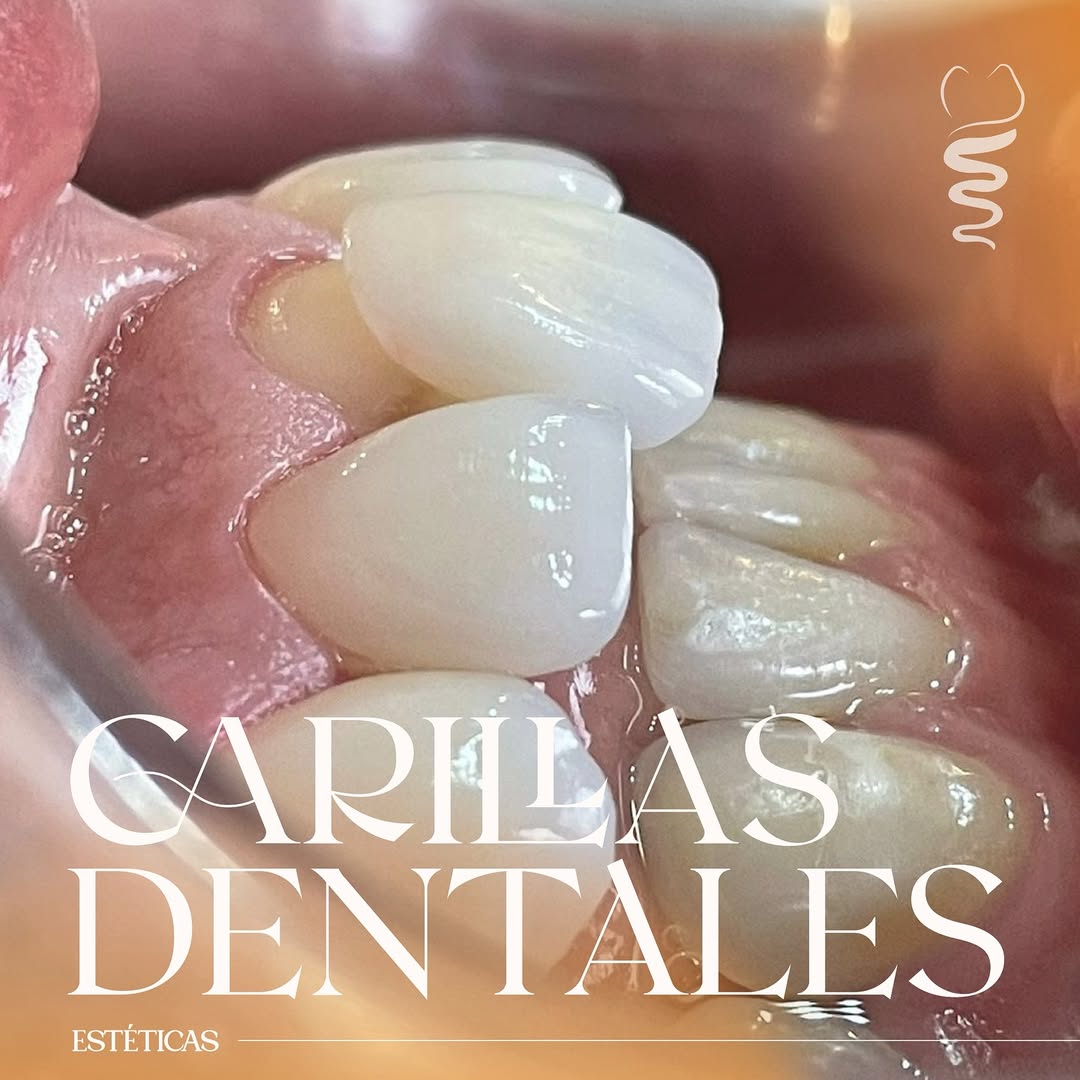Proceso de colocación de las carillas dentales