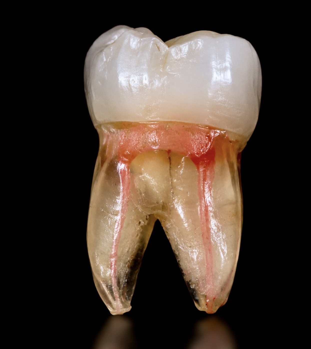 Endodoncia: raíz dental con el nervio (conducto) afectado — caso real