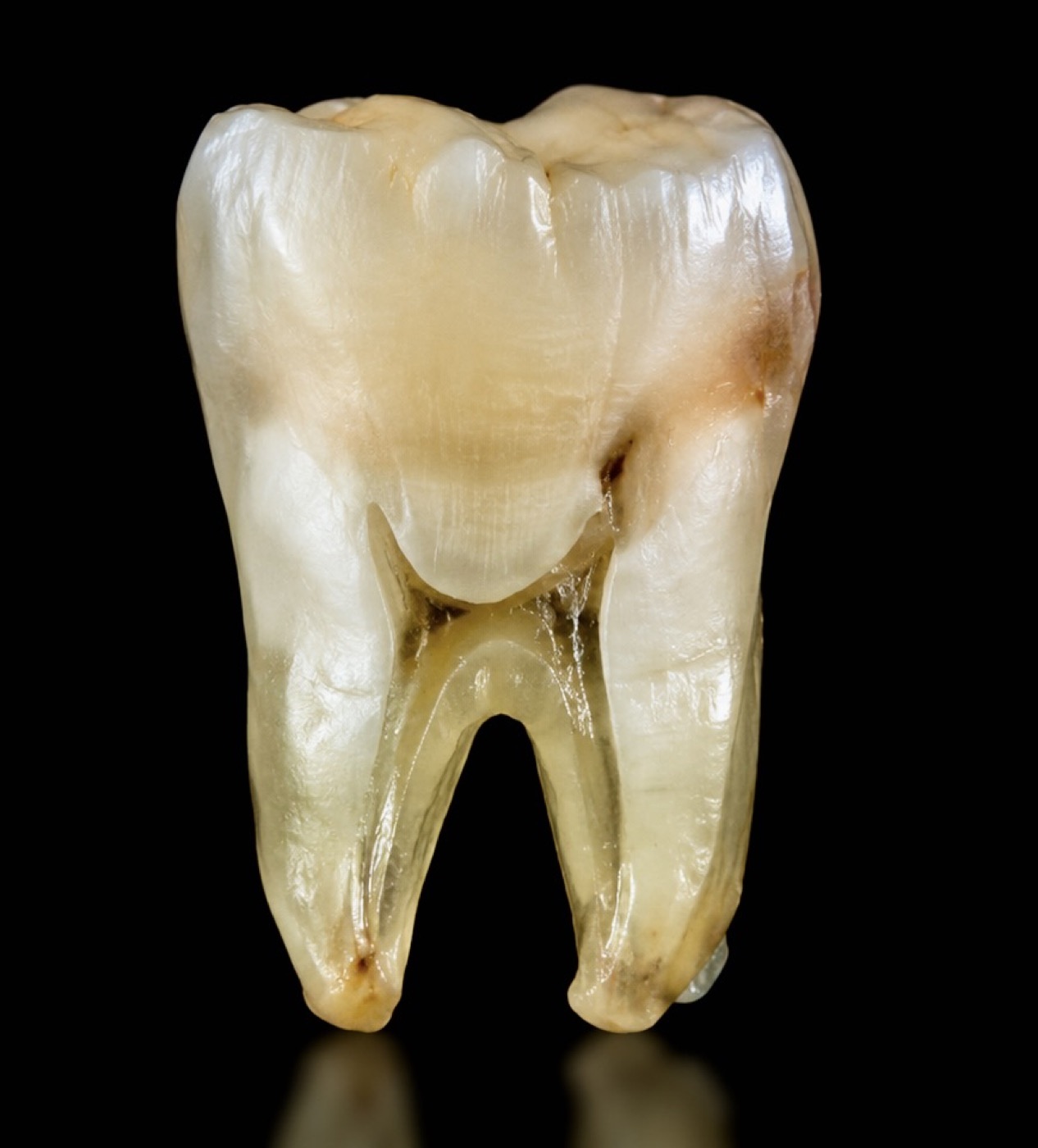 Diagnóstico: caries profunda que alcanza el nervio del diente