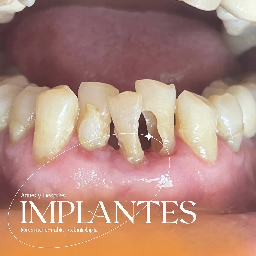 Antes: pieza dental perdida antes del implante — caso real