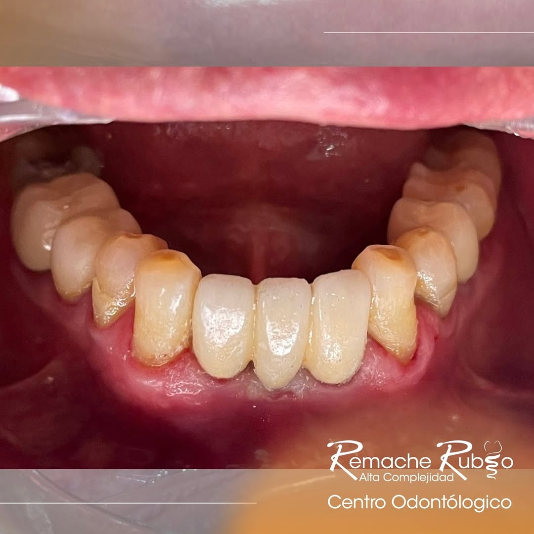 Resultado: implante dental terminado y funcional