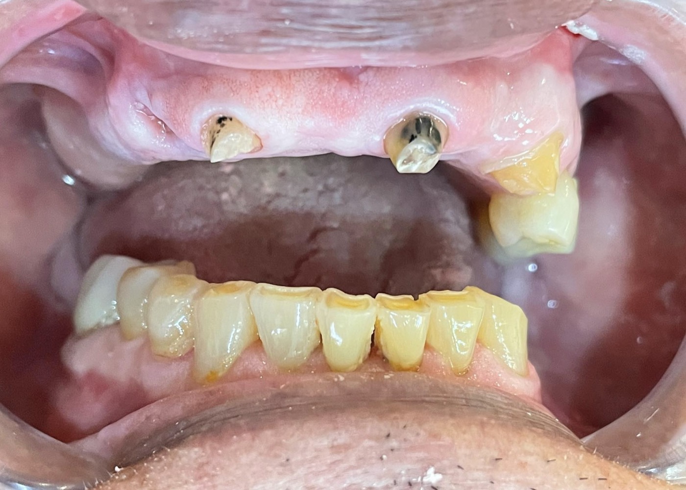 Antes: piezas dentales perdidas