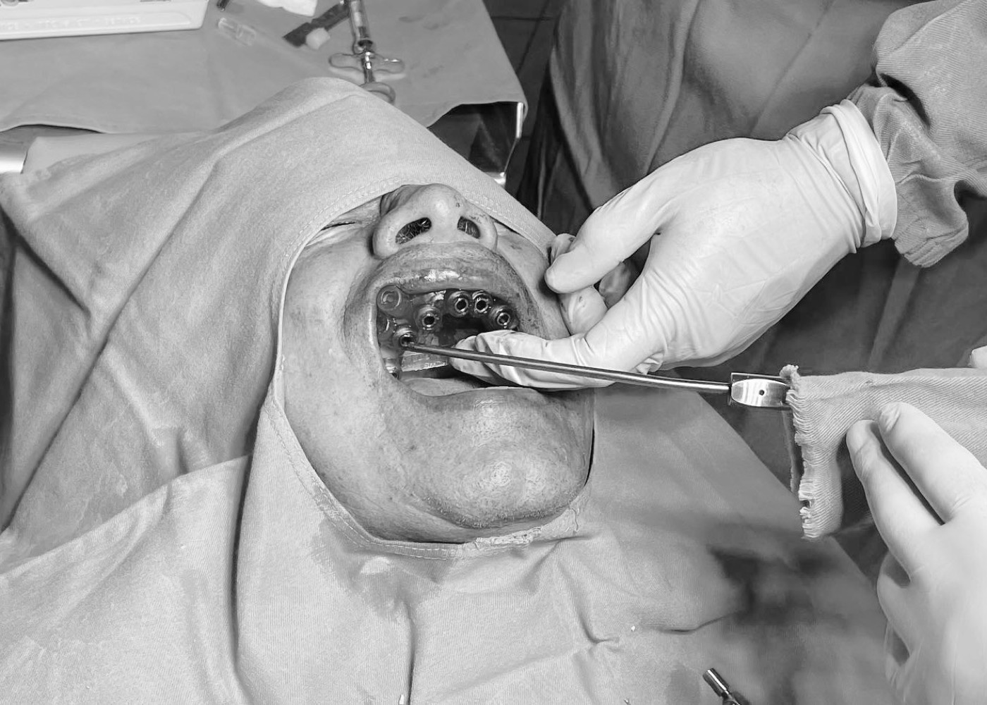 Cirugía de colocación de implantes múltiples con guía quirúrgica