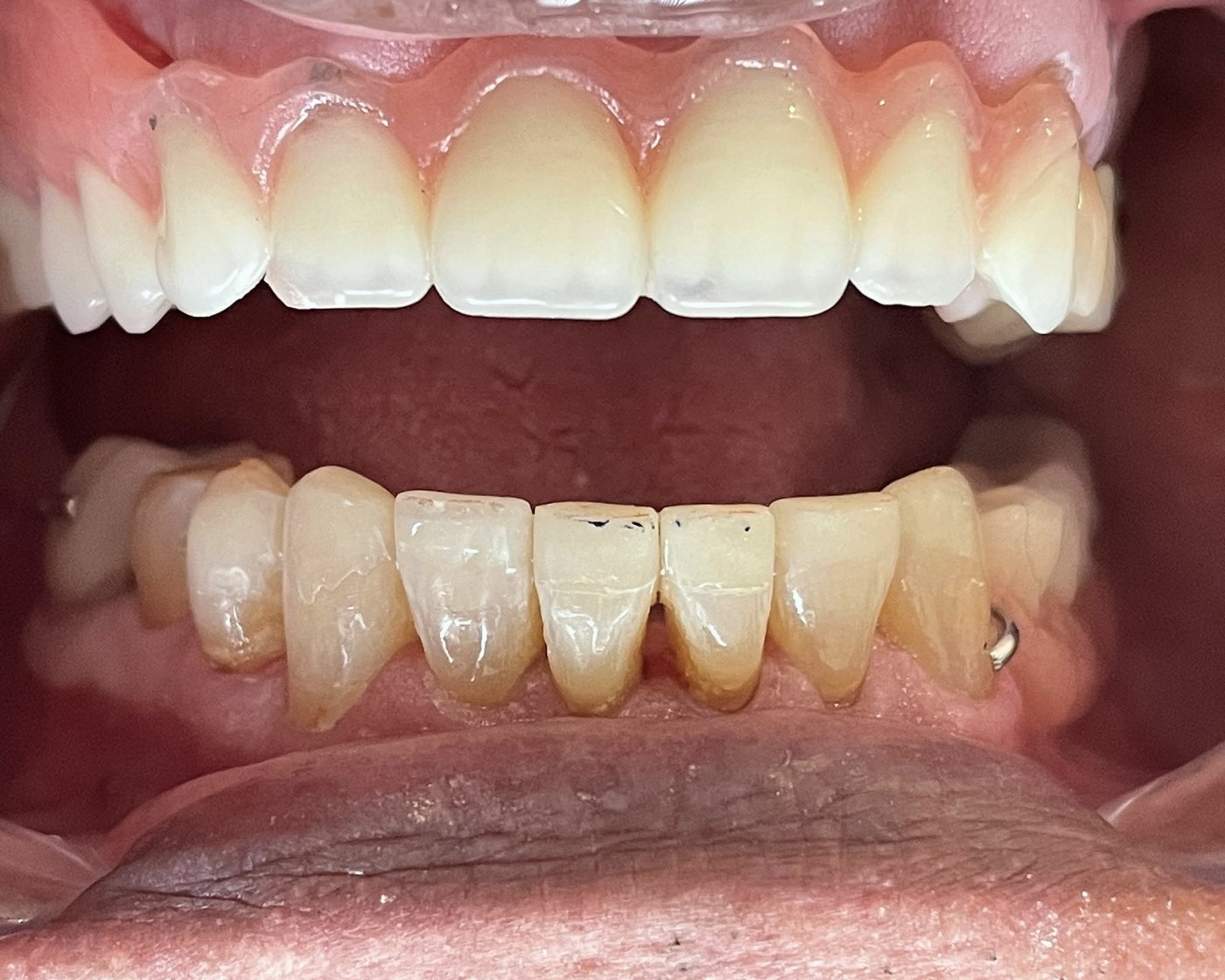 Después: resultado del caso de implantes dentales