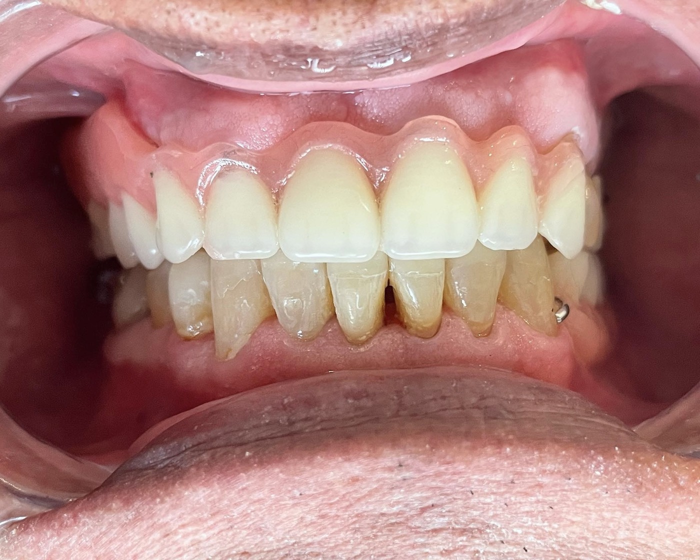 Resultado del caso de implantes múltiples y cirugía avanzada