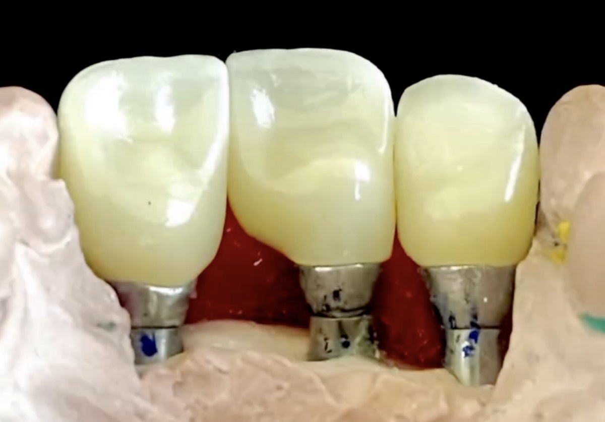 Prótesis sobre implantes dentales