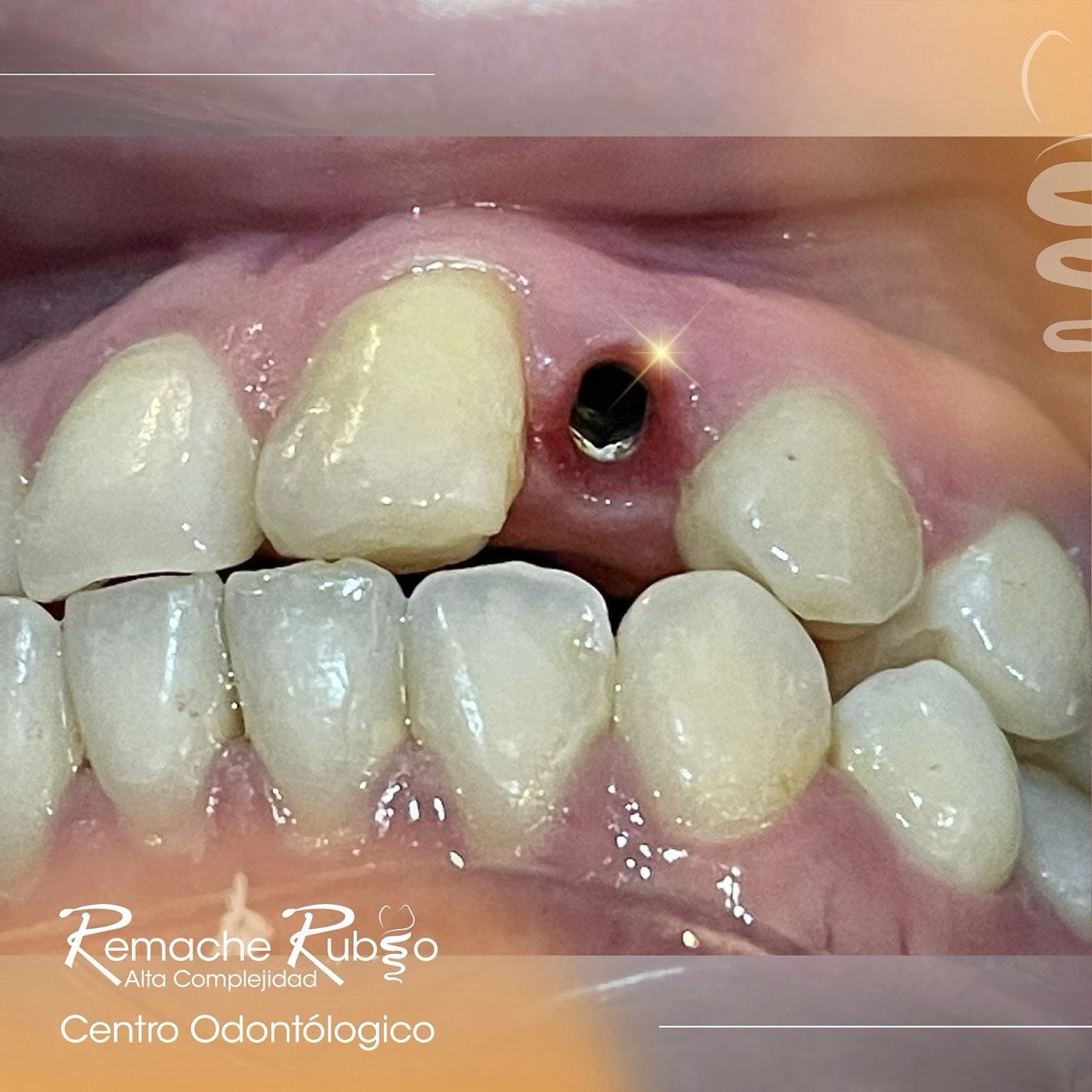 Ortodoncia combinada con implantes dentales para mejor estética