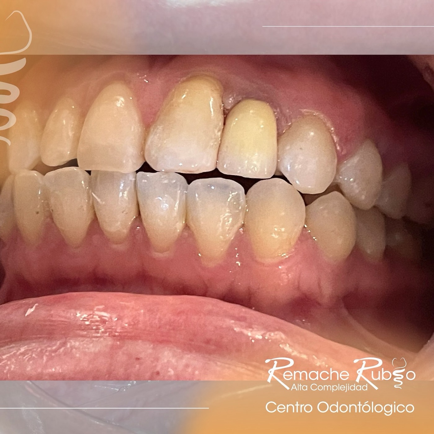 Resultado final del tratamiento de ortodoncia: sonrisa alineada