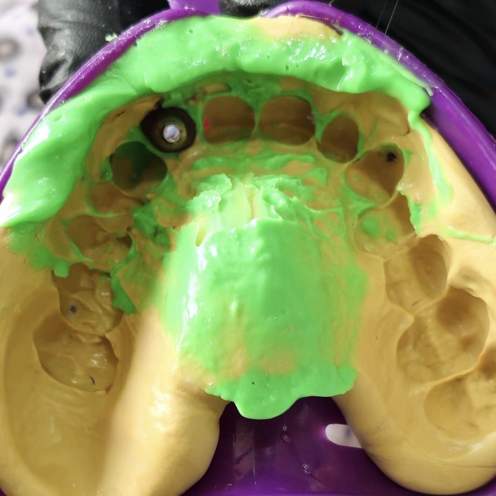 Molde dental para fabricar la prótesis