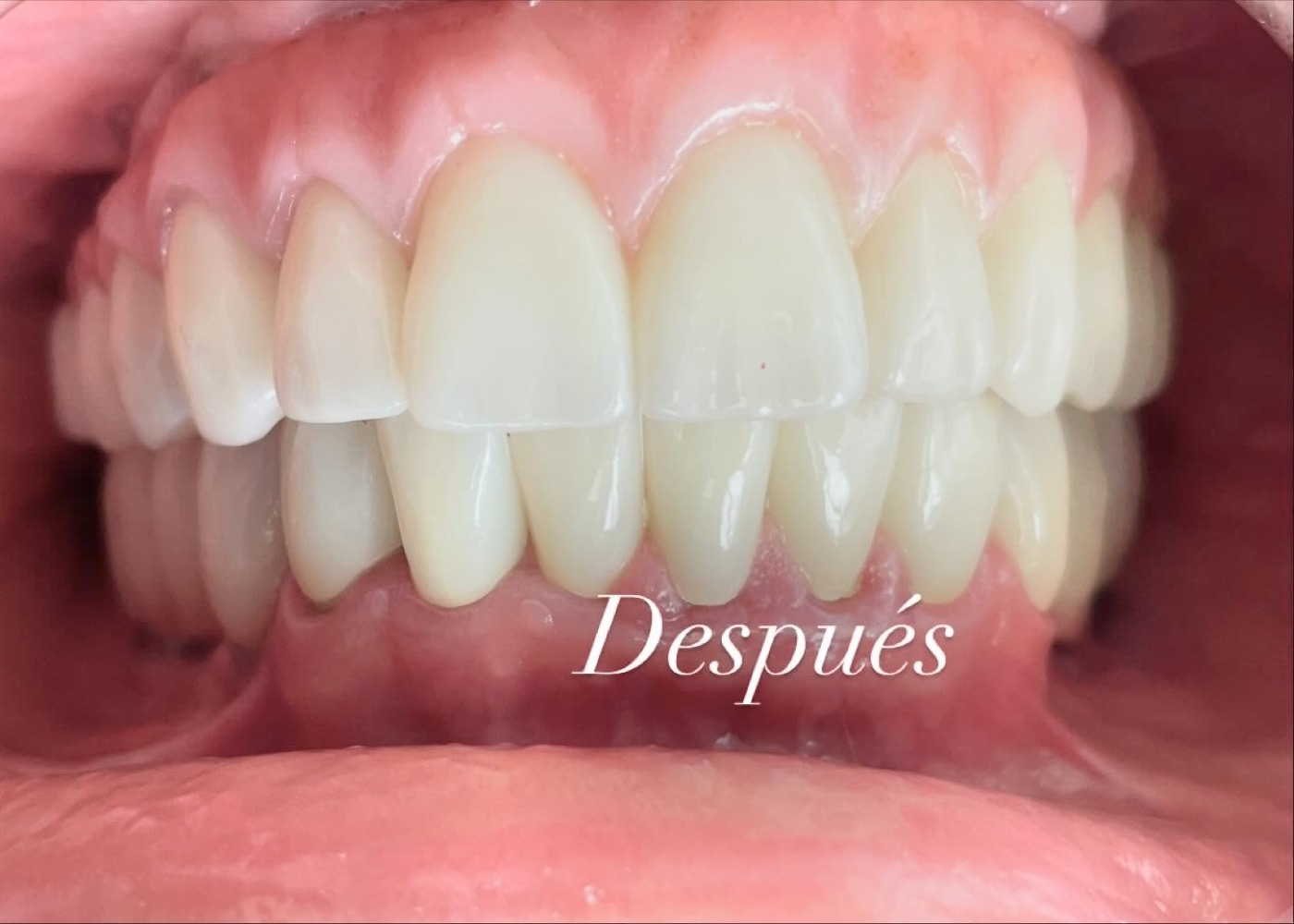 Después: resultado final de la rehabilitación oral compleja con implantes múltiples