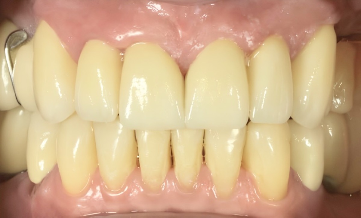 Rehabilitación oral completa